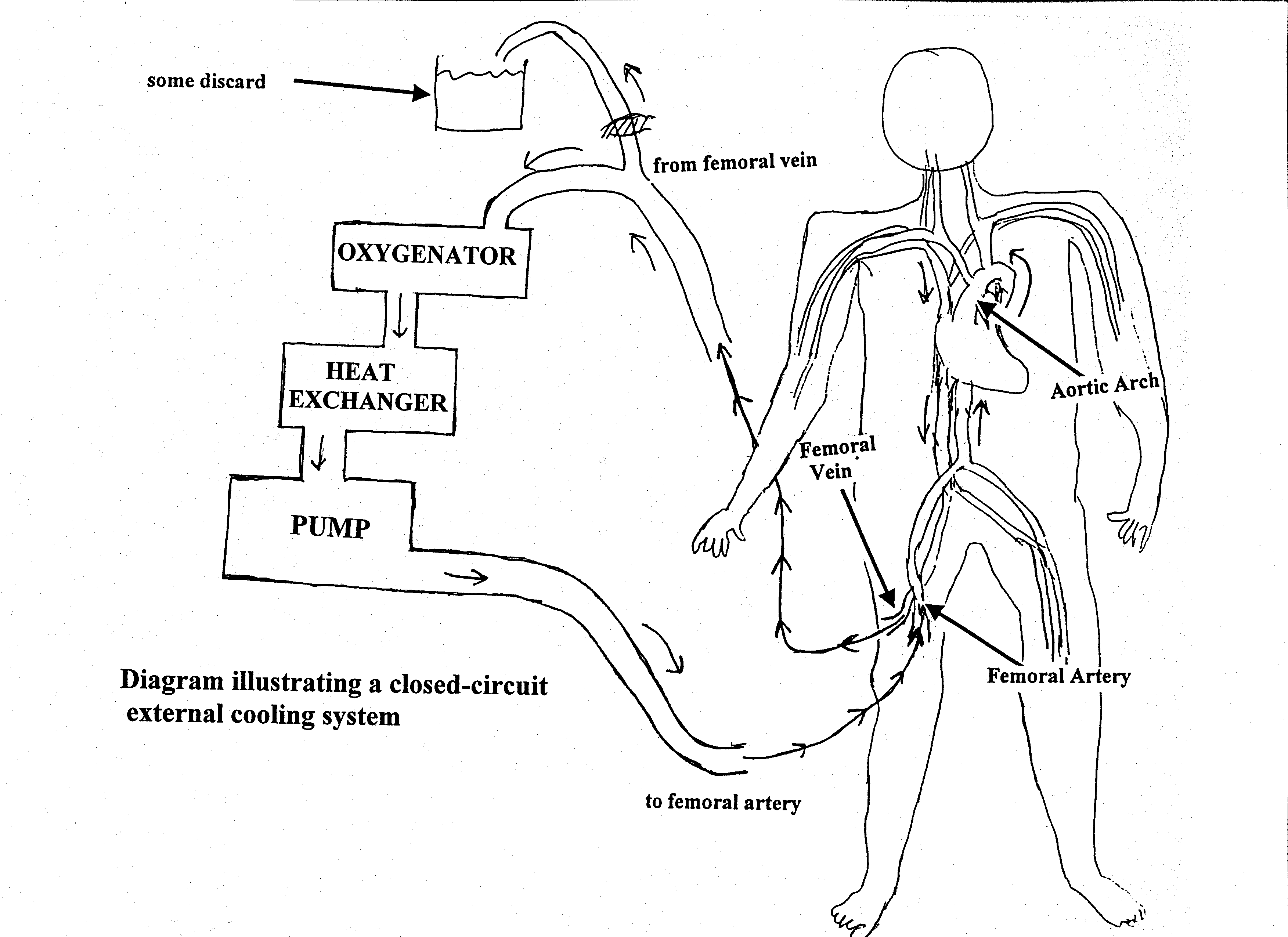 [ Closed Circuit Perfusion of a Cryonics Patient ]